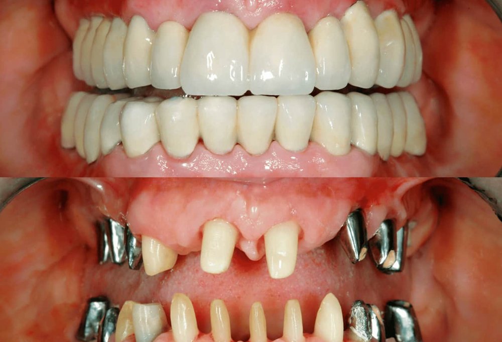 Full mouth rehabilitation in Bhubaneswar at Pathak Dental Clinic