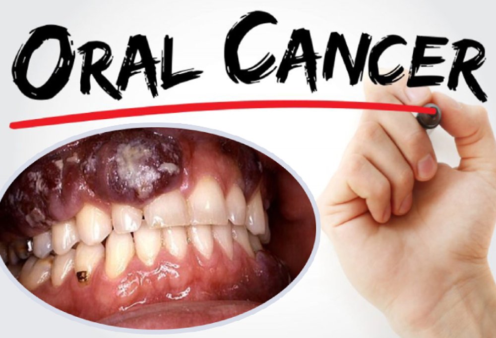 Oral cancer treatment in Bhubaneswar at Pathak Dental Clinic