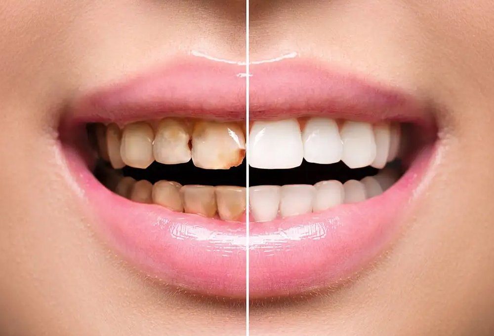 What Is Scaling and Polishing