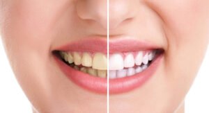 Read more about the article Teeth Whitening & Bleaching: Procedure, Benefits, Cost & Safety Explained