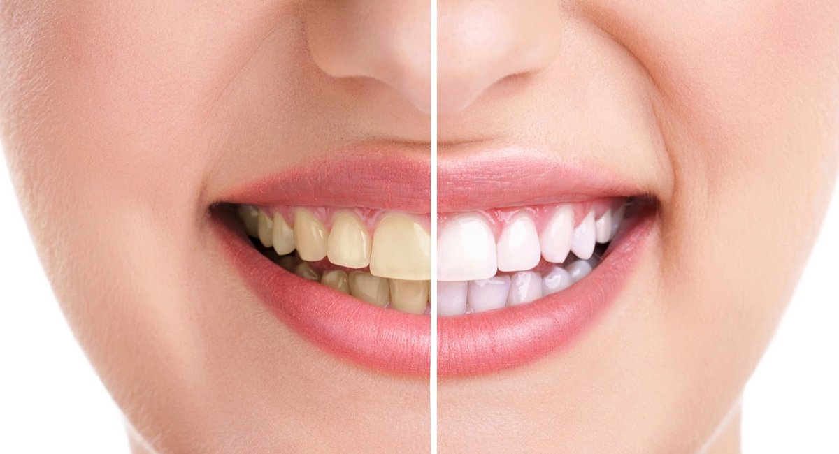 Teeth Whitening & Bleaching: Procedure, Benefits, Cost & Safety Explained