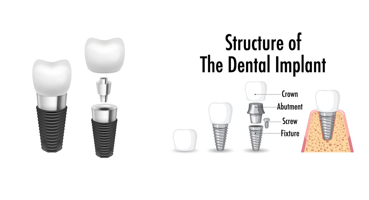 Dental Implants in Bhubaneswar – Permanent & Natural Tooth Replacement
