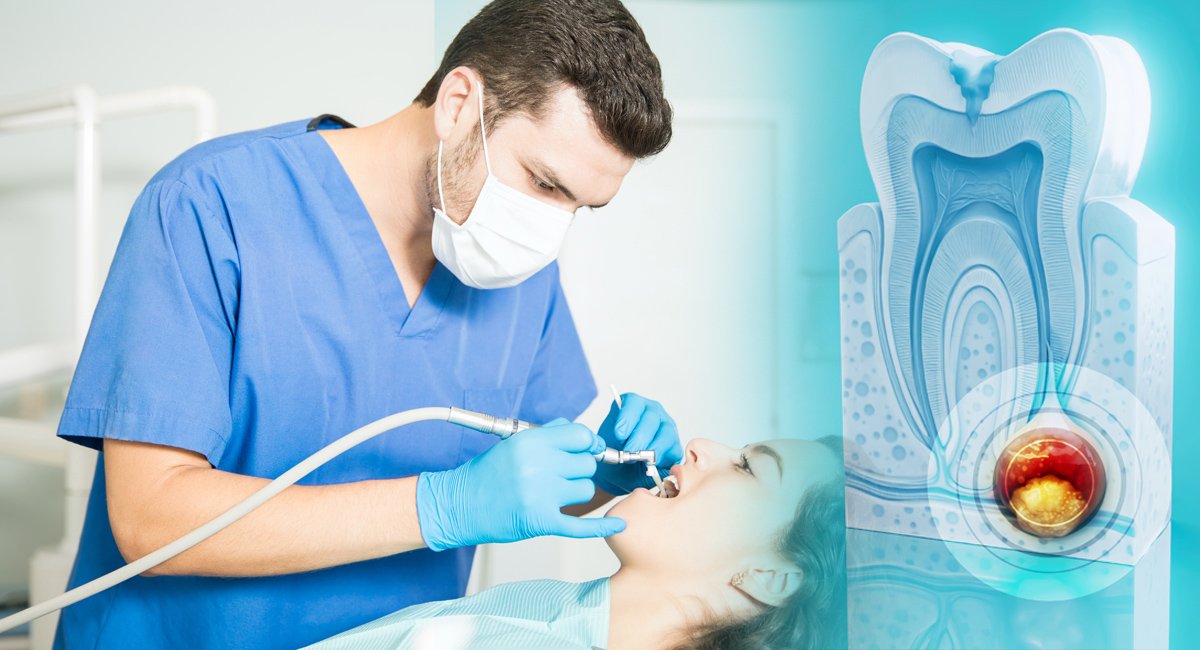 Root Canal Treatment in Bhubaneswar – Safe & Painless Tooth Saving Procedure